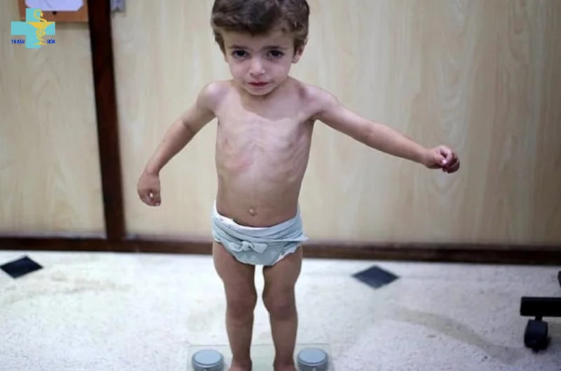 còi xương và suy dinh dưỡng ở trẻ
